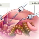 ഗര്ഭപാത്രം നീക്കം ചെയ്യുന്നത് എപ്പോള്? Garbhampathram110321b