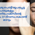 മുഖക്കുരു പൊട്ടി രൂപപ്പെട്ട പാടുകളും ചിക്കന്പോക്സിന്റെ പാടുകളും 48 ദിവസം കൊണ്ട് മാറും; വീട്ടിൽ ചെയ്യാവുന്ന ഔഷധക്കൂട്ട് ഇതാ... pimple