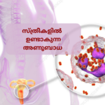 സ്ത്രീകളിൽ ഉണ്ടാകുന്ന അണുബാധ സ്ത്രീകളിൽ ഉണ്ടാകുന്ന അണുബാധ